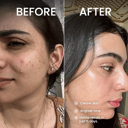 Clear Complexion 15-Days Challenge -Real, Visible Skin Transformation