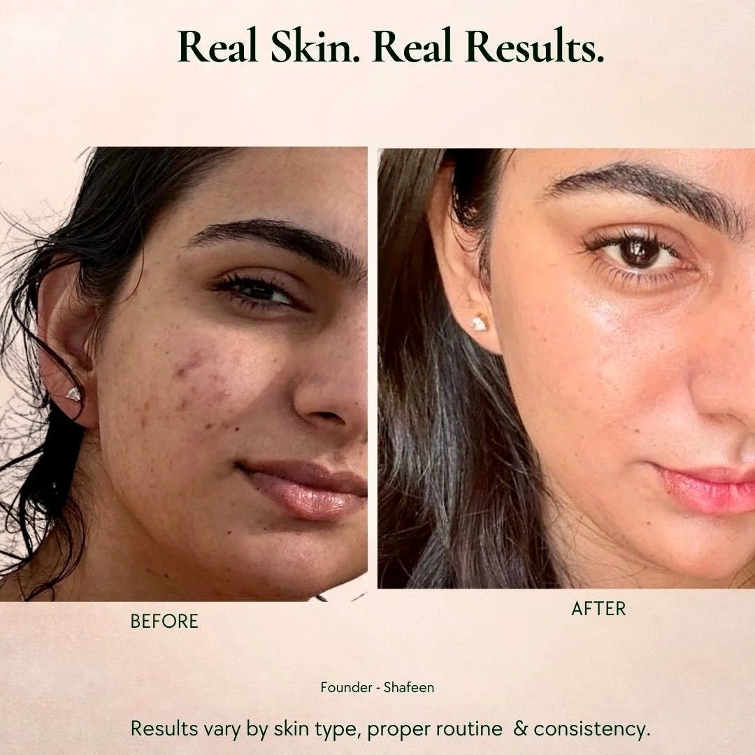 Before and after comparison of a person's face with text 'Real Skin. Real Results.