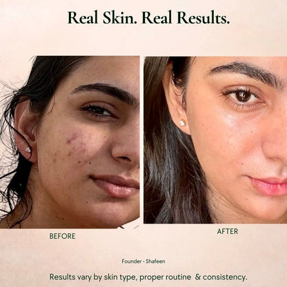 Before and after comparison of a person's face with text 'Real Skin. Real Results.